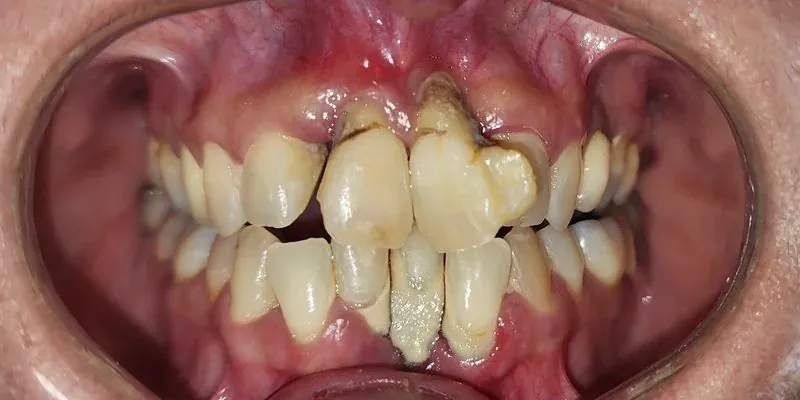 Situación inicial: dentición superior con pérdida ósea avanzada