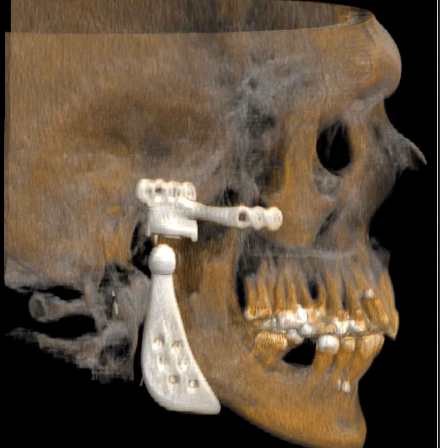 Reconstrucción tomográfica en tres dimensiones de una prótesis total de articulación temporomandibular