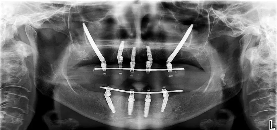 Implantes cigomáticos instalados con rehabilitación fija en ambas arcadas