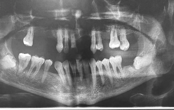 Radiografía panorámica inicial con pérdida ósea generalizada y dientes comprometidos