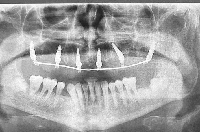 Radiografía de control con implantes y prótesis fija instalados en el maxilar superior