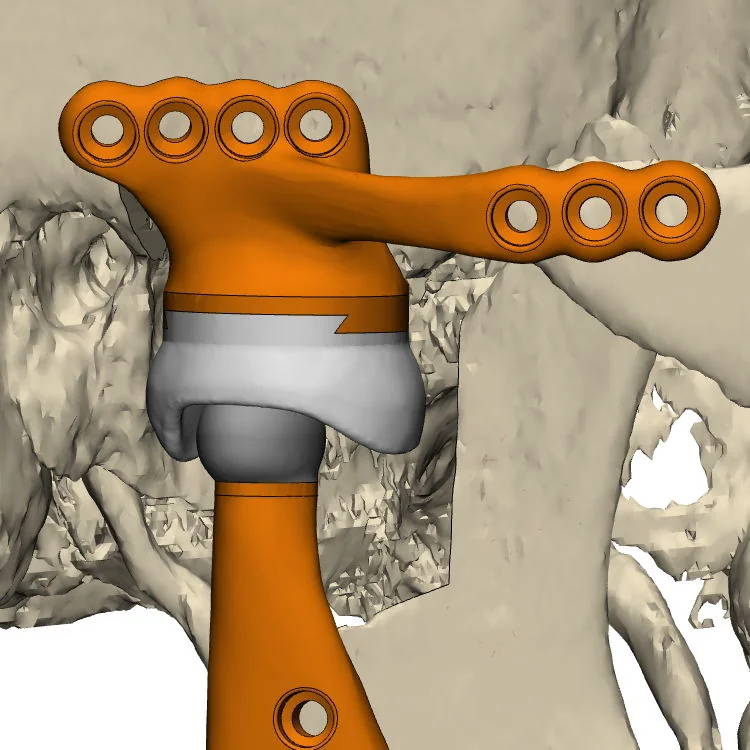 Diseño tridimensional del componente protésico de articulación temporomandibular sobre el modelo óseo del paciente